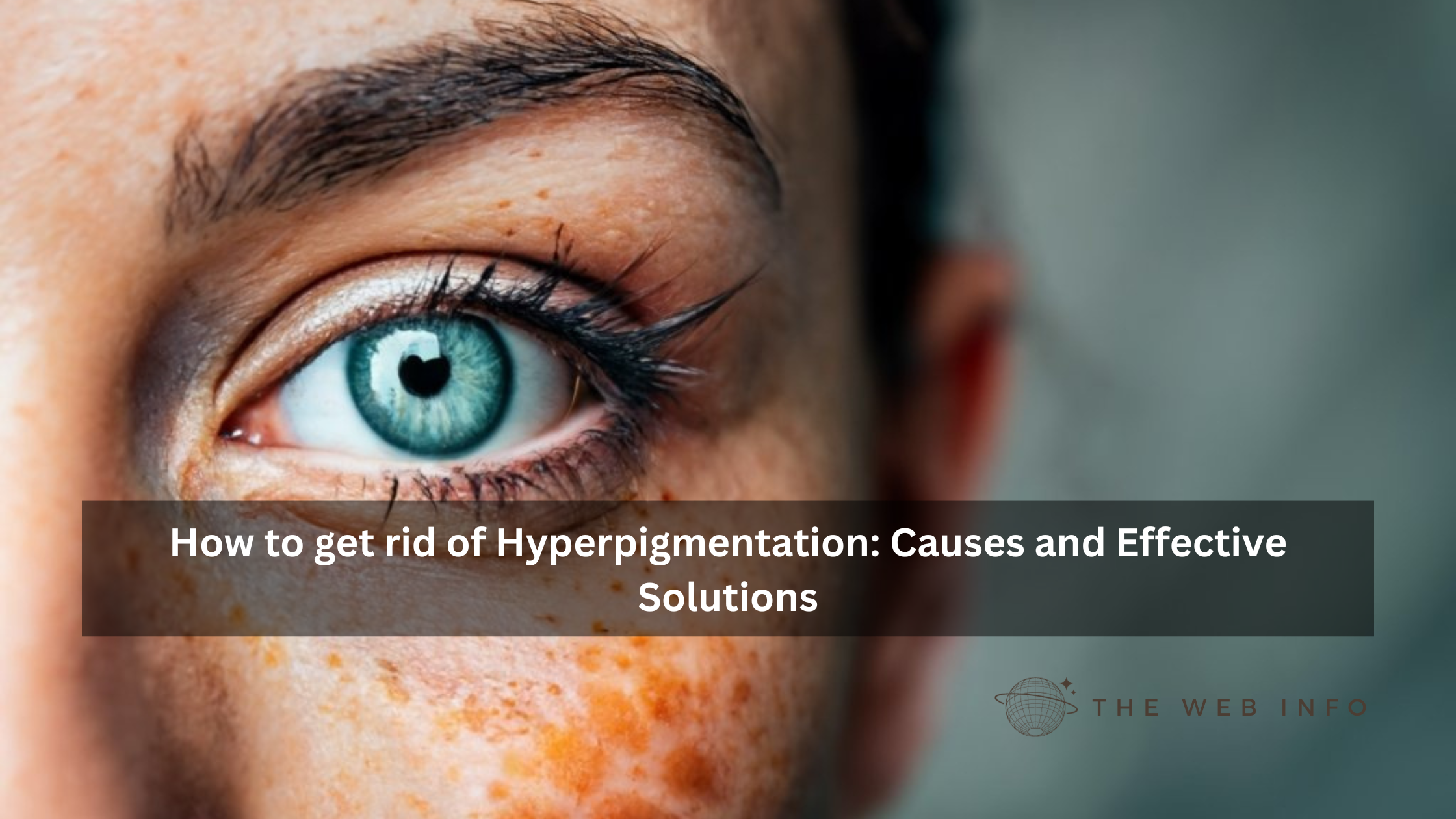 How to get rid of Hyperpigmentation: Causes and Effective Solutions